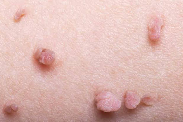 زگیل تناسلی