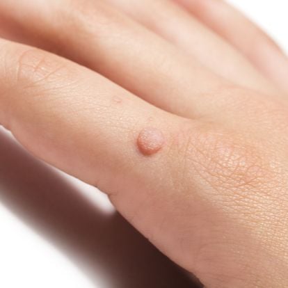 زگیل تناسلی عفونت انگشت