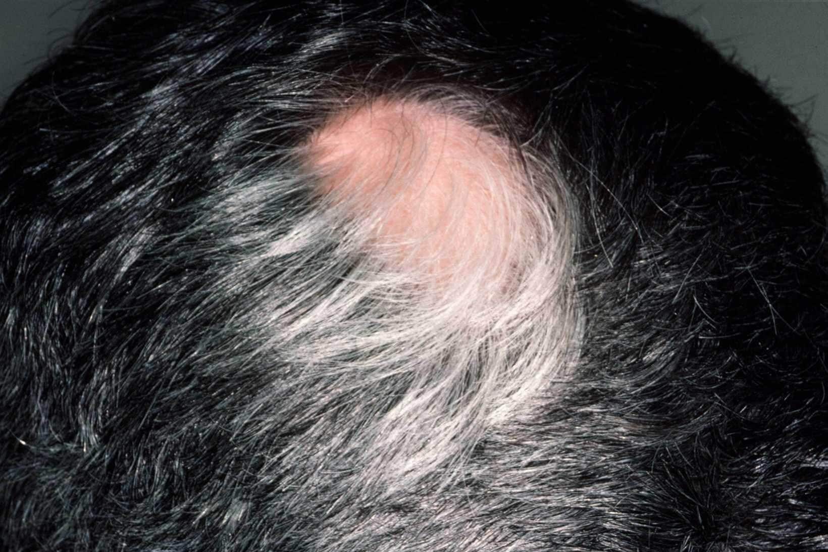 آلوپسی آره آتا یک بیماری خوش خیم ریشه مو است که منجر به طاسی لکه ای (=آلوپسی) موهای سر می شود.