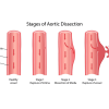 Aortic-Dissection