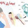 BPPV