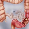 Bowel-Obstruction_-Signs-Symptoms-and-Emergency-Management