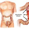 Diverticular-Disease