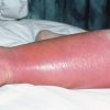 M1300283-Inflammation_due_to_cellulitis_on_the_lower_leg-1456x967