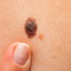 epi-blog-melanoma-scaled