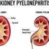 kidney_pyelenephritis